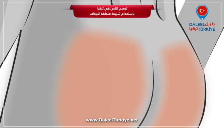 ترميم الثدي في تركيا باستخدام شريحة منطقة الأرداف