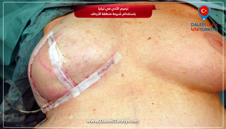 ترميم الثدي في تركيا باستخدام شريحة منطقة الأرداف٢