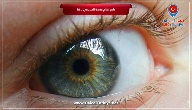علاج اعتام عدسة العين في تركيا