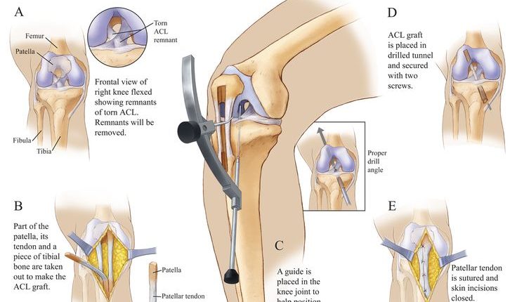 Anterior-Cruciate-Ligament-Surgery-جراحة-ترميم-الرباط-الصليبي-الأمامي-في-تركيا