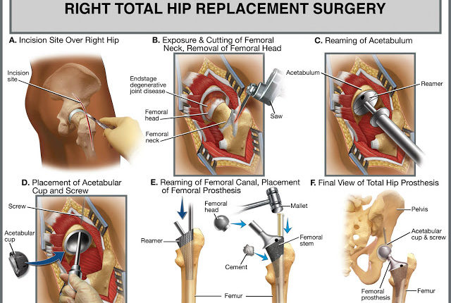 Hip-replacement-surgery-in-Turkey2