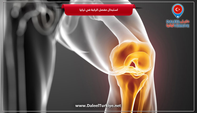 استبدال مفصل الركبة في تركيا