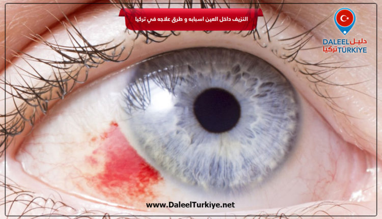 النزيف داخل العين اسبابه و طرق علاجه في تركيا