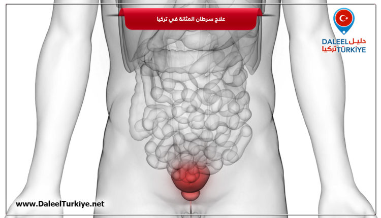 علاج سرطان المثانة في تركيا