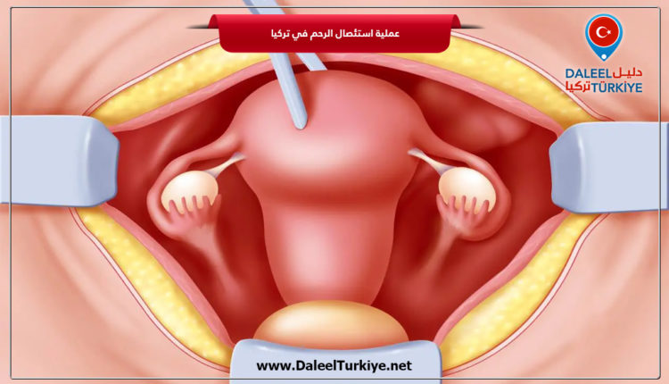 عملية استئصال الرحم في تركيا