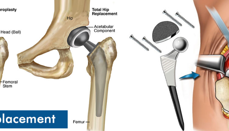 Hip-replacement-surgery-in-Turkey