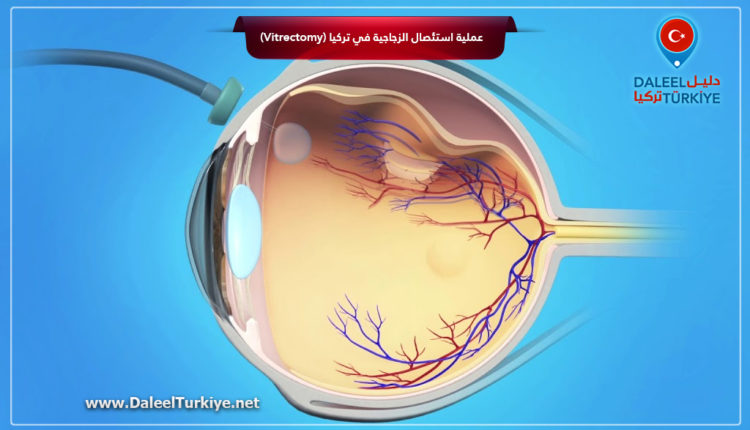 عملية استئصال الزجاجية في تركيا (Vitrectomy)