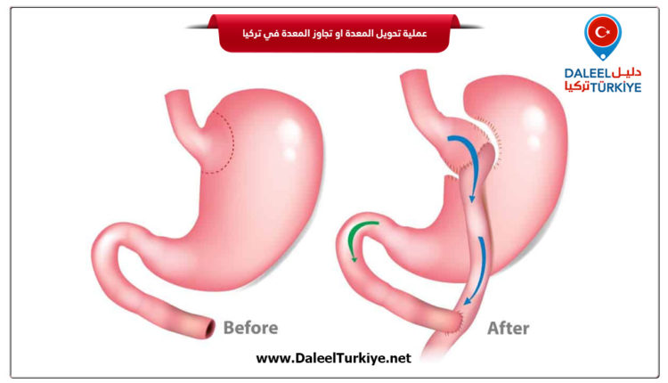 عملية تحويل المعدة او تجاوز المعدة في تركيا