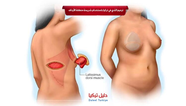 ترميم الثدي في تركيا باستخدام شريحة منطقة الأرداف