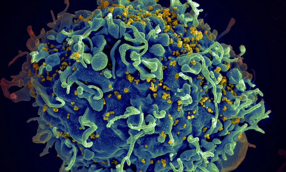 An electron microscope image shows a human T cell, in blue, under attack by HIV, in yellow. (Seth Pincus, Elizabeth Fischer, Austin Athman/National Institute of Allergy and Infectious Diseases/AP)