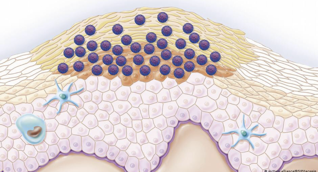 دراسة أسترالية تربط بين عدوى فيروسية وسرطان البروستاتا