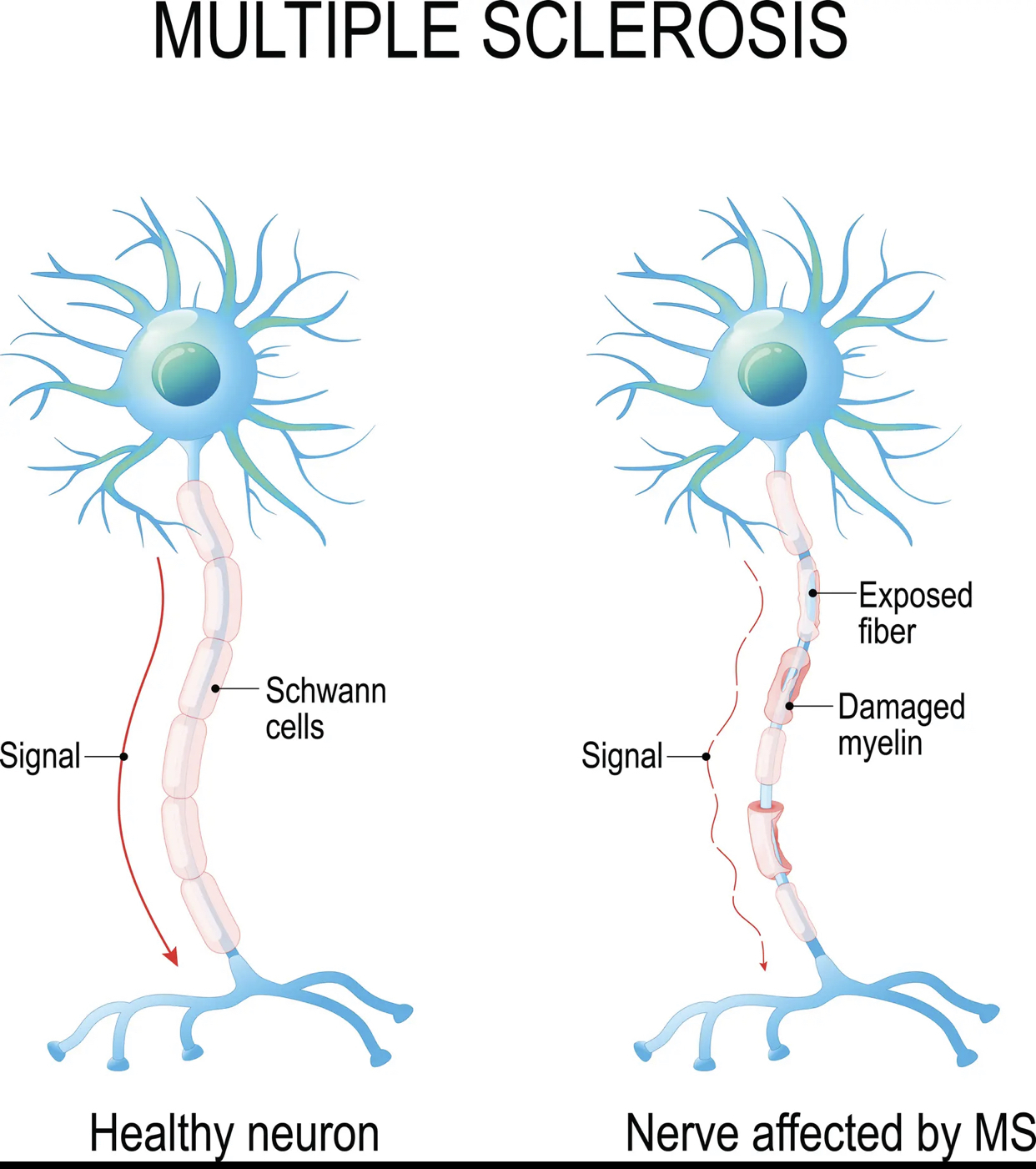 صورة تشرح ما يفعله مرض التصلب المتعدد بالألياف العصبية