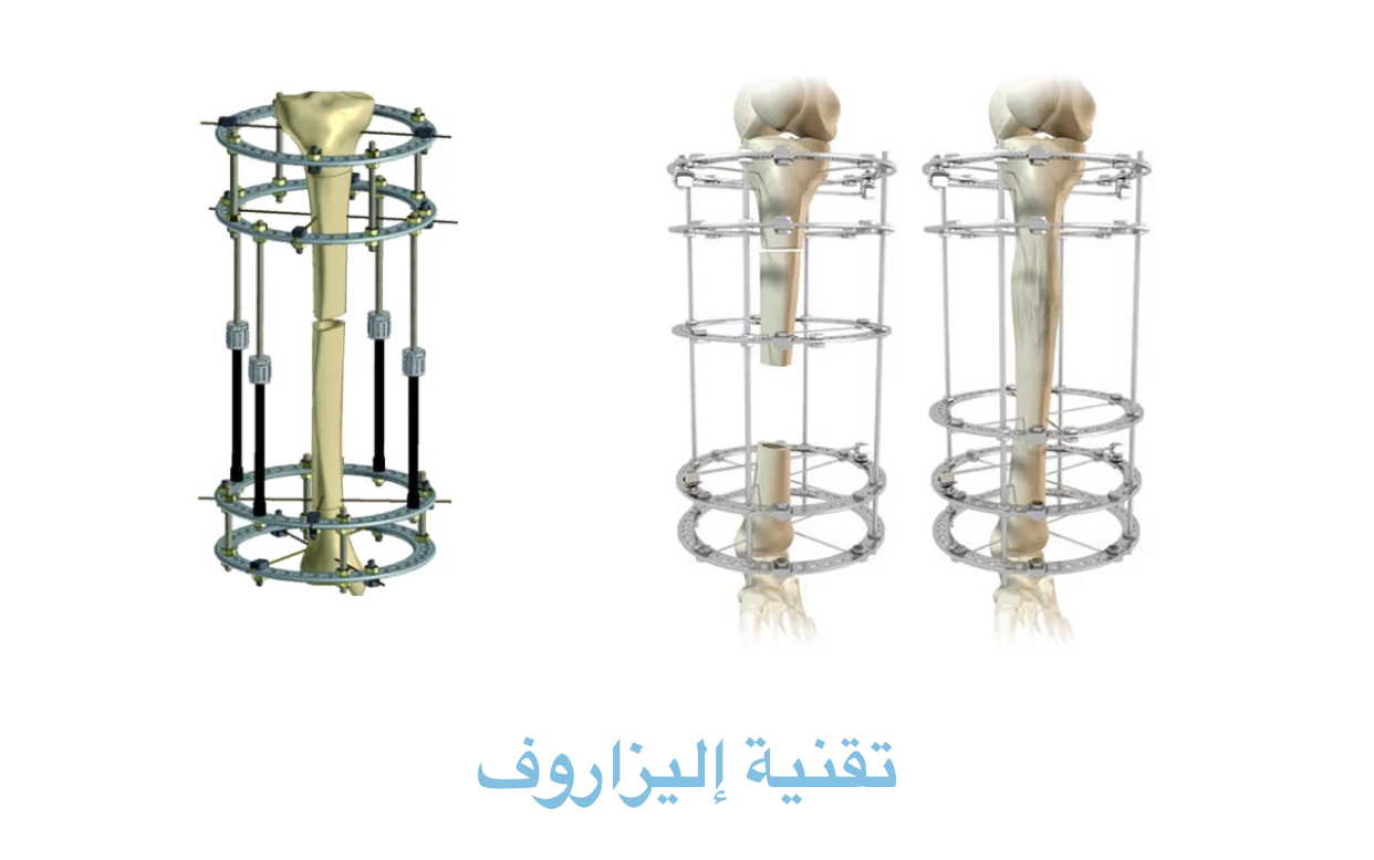طريقة إليزاروف لتطويل القامة في تركيا 